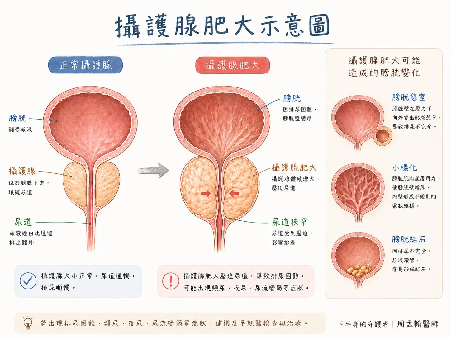 明明才上過，怎麼又要去？搞懂攝護腺肥大如何擠壓你的排尿通道