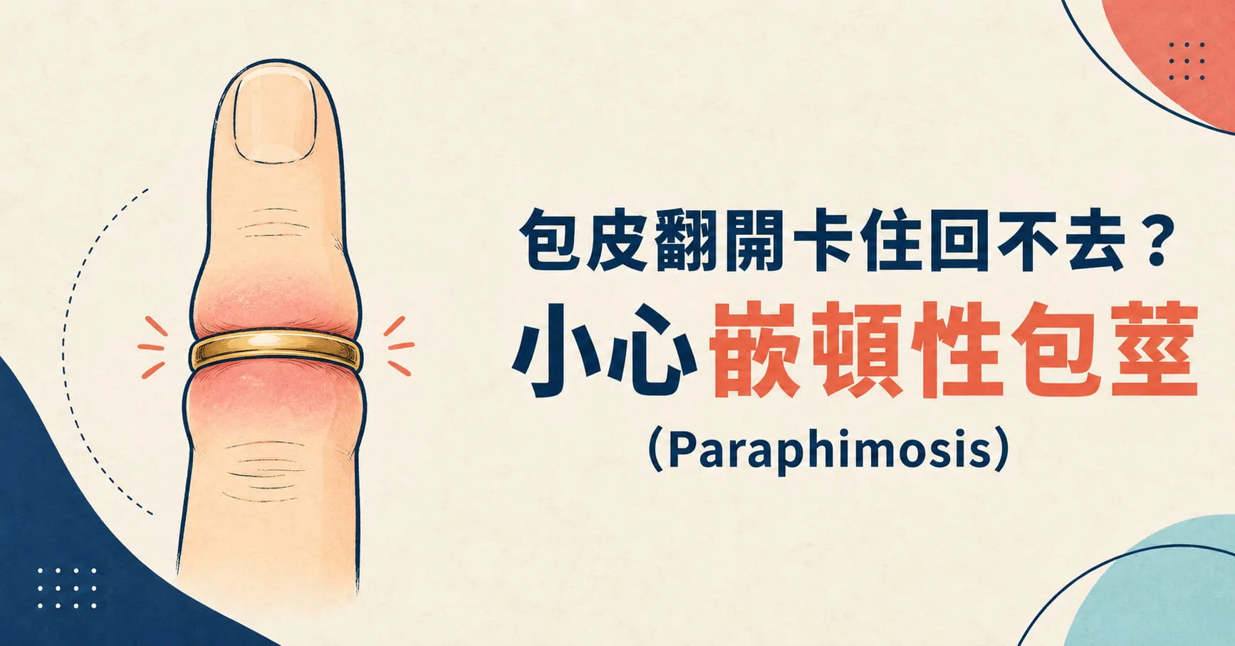 包皮翻開卡住回不去？小心嵌頓性包莖（Paraphimosis）