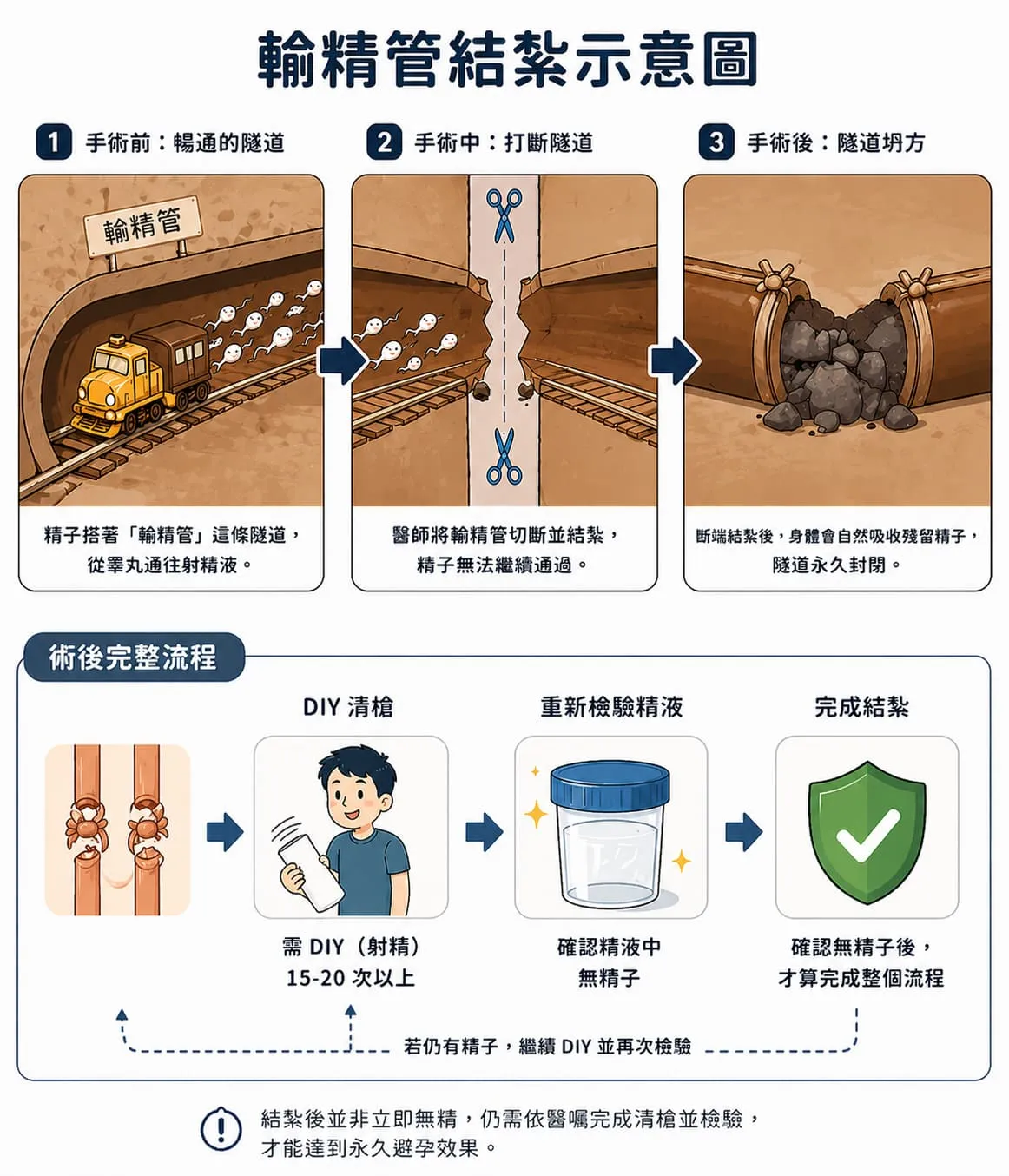 輸精管結紮：男性避孕的穩定選擇與術後安心指南